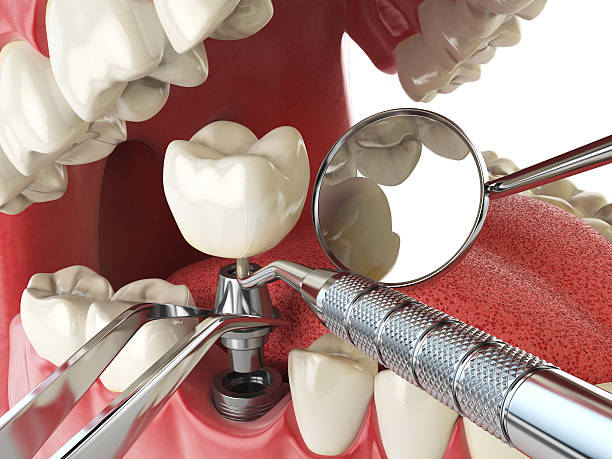 Best Emergency Tooth Extraction in Heidelberg, TX
